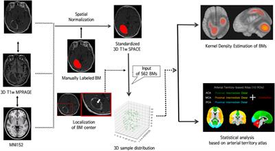 Brain Metastases From Lung Adenocarcinoma May Preferentially Involve the Distal Middle Cerebral Artery Territory and Cerebellum